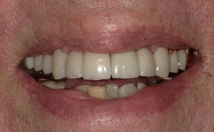 After Teeth