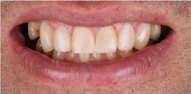 After Teeth