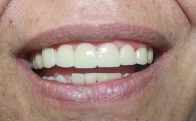 After Teeth