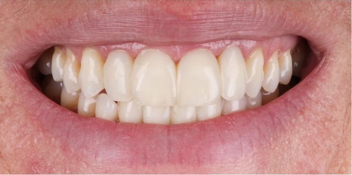 After Teeth