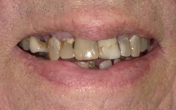 Before Teeth