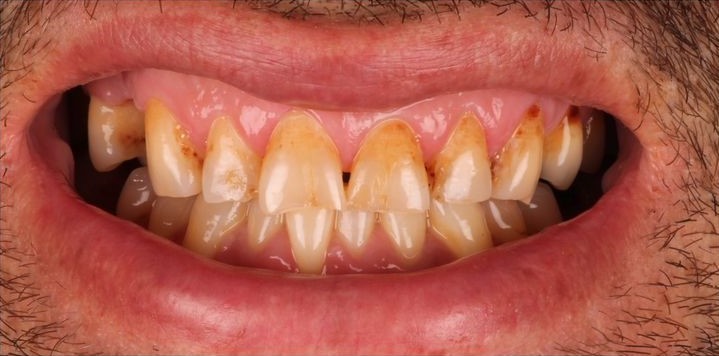 Before Teeth