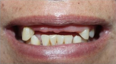 Before Teeth