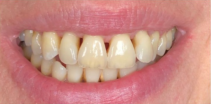 Before Teeth