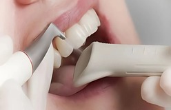 EMS_Painless_Teeth_Cleaning