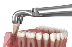 Extraction Wisdom Tooth Removal