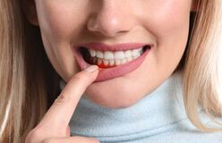 Gum Diseases