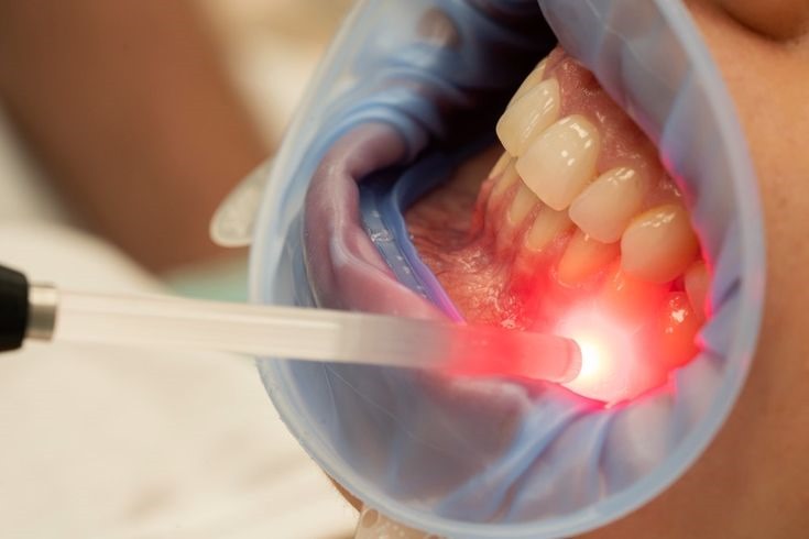 Laser Dentistry