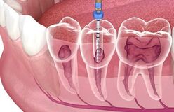 Single sitting root canal-treatment