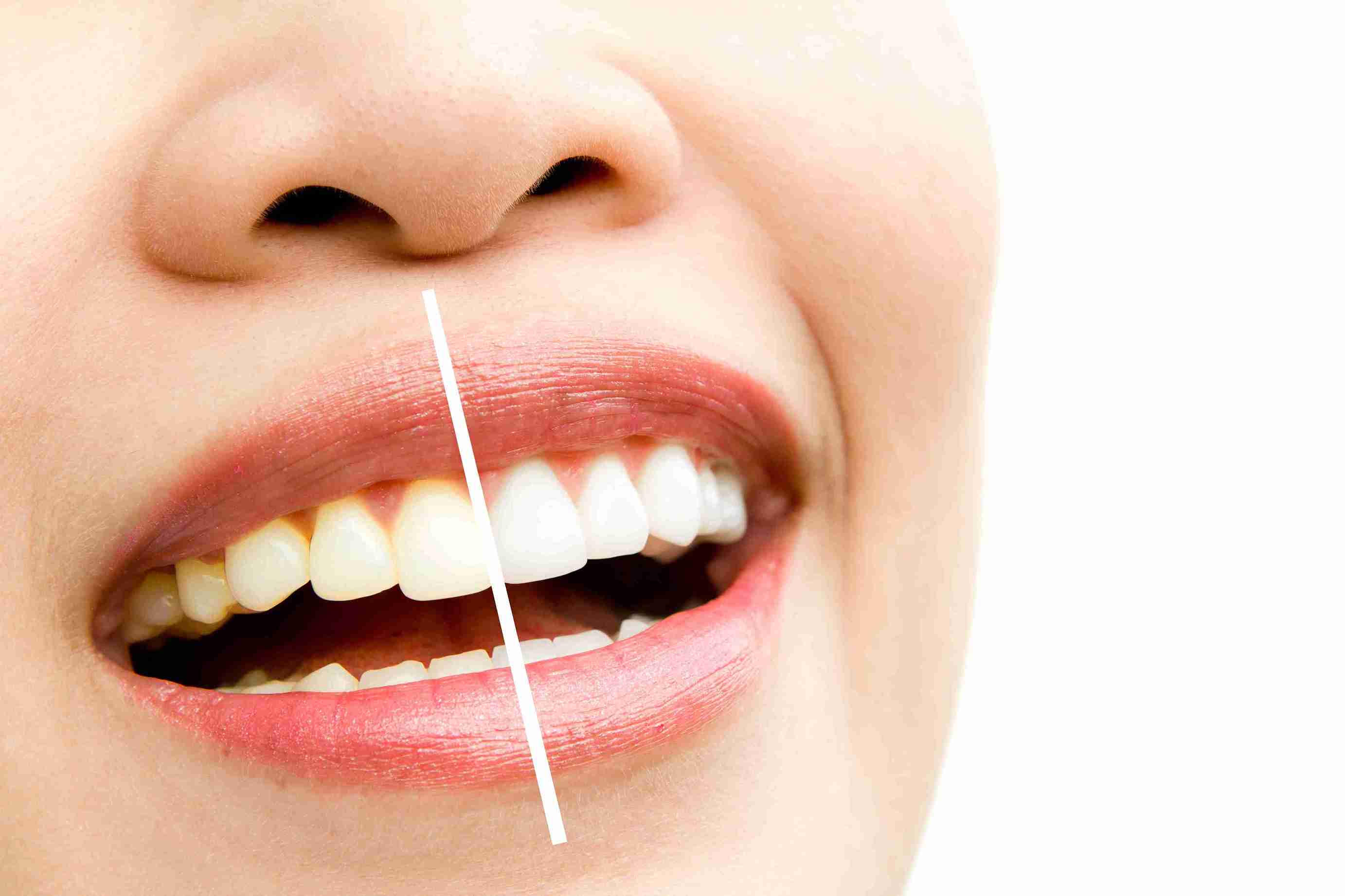 Teeth-Whitening