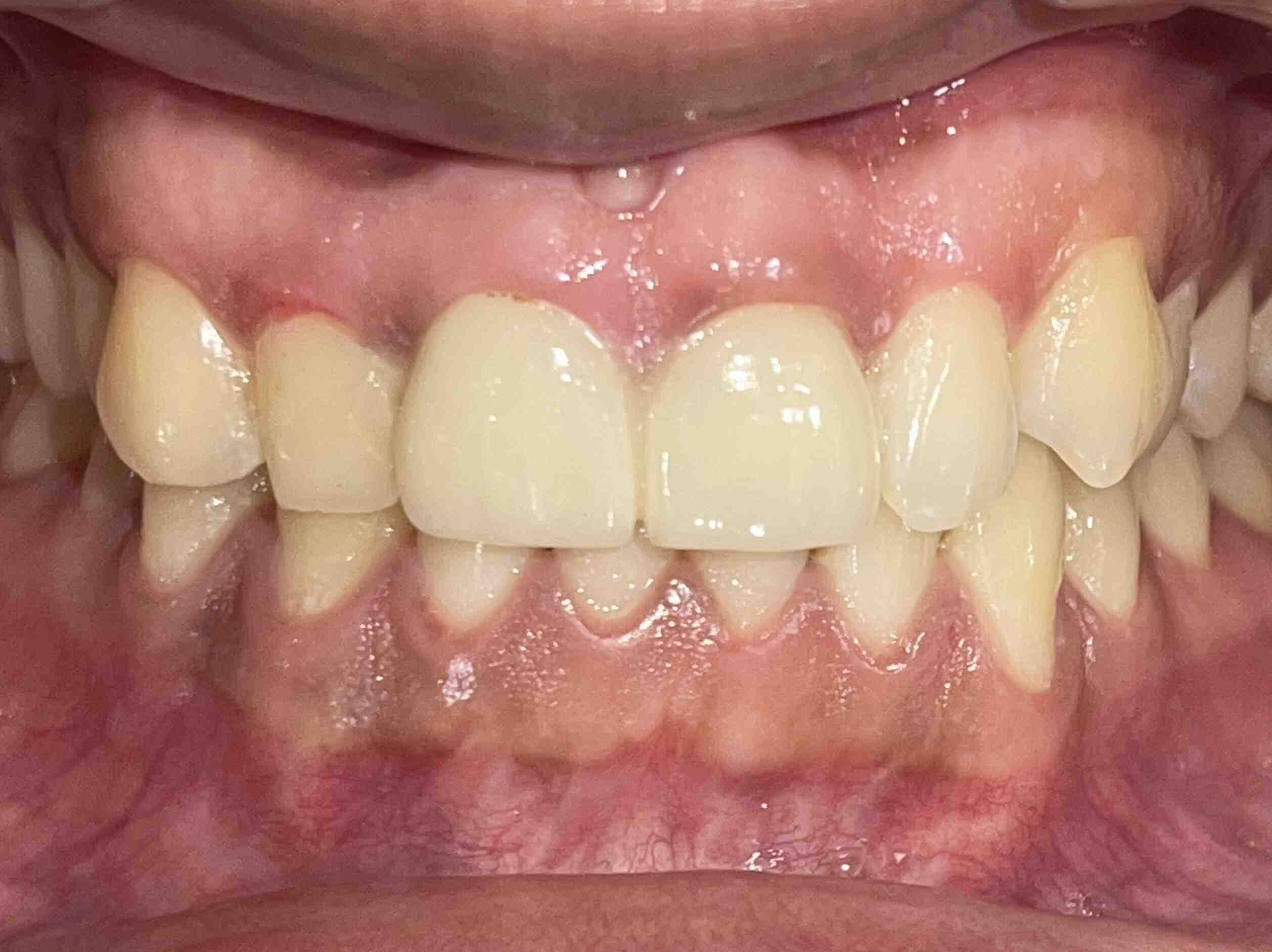 After Teeth