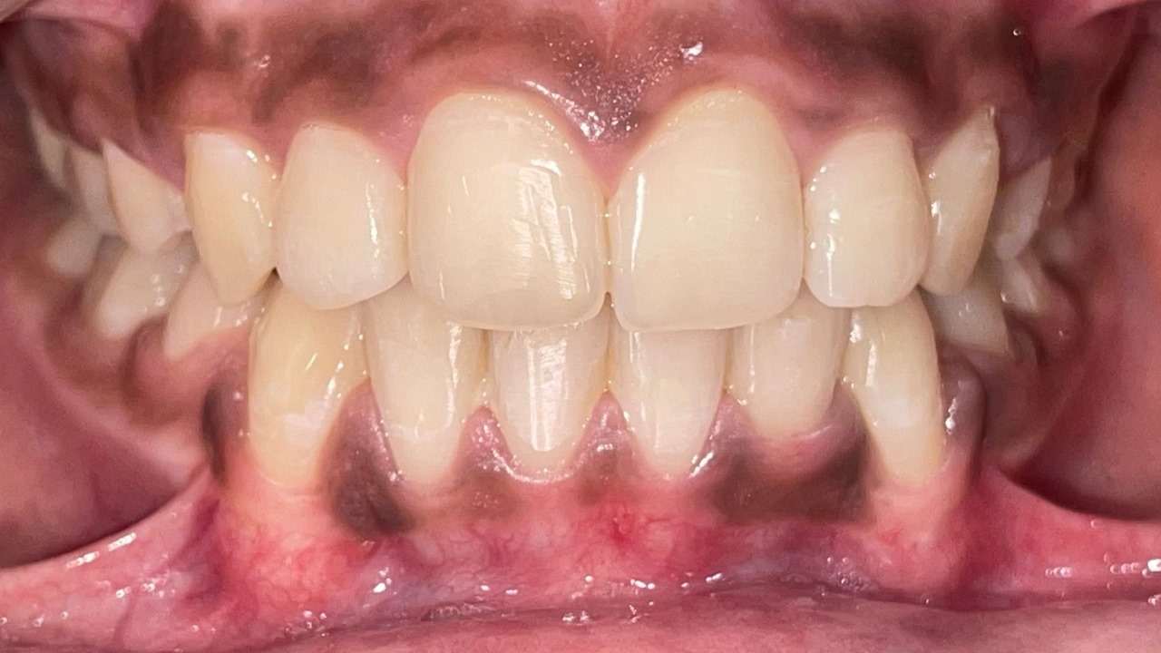 After Teeth