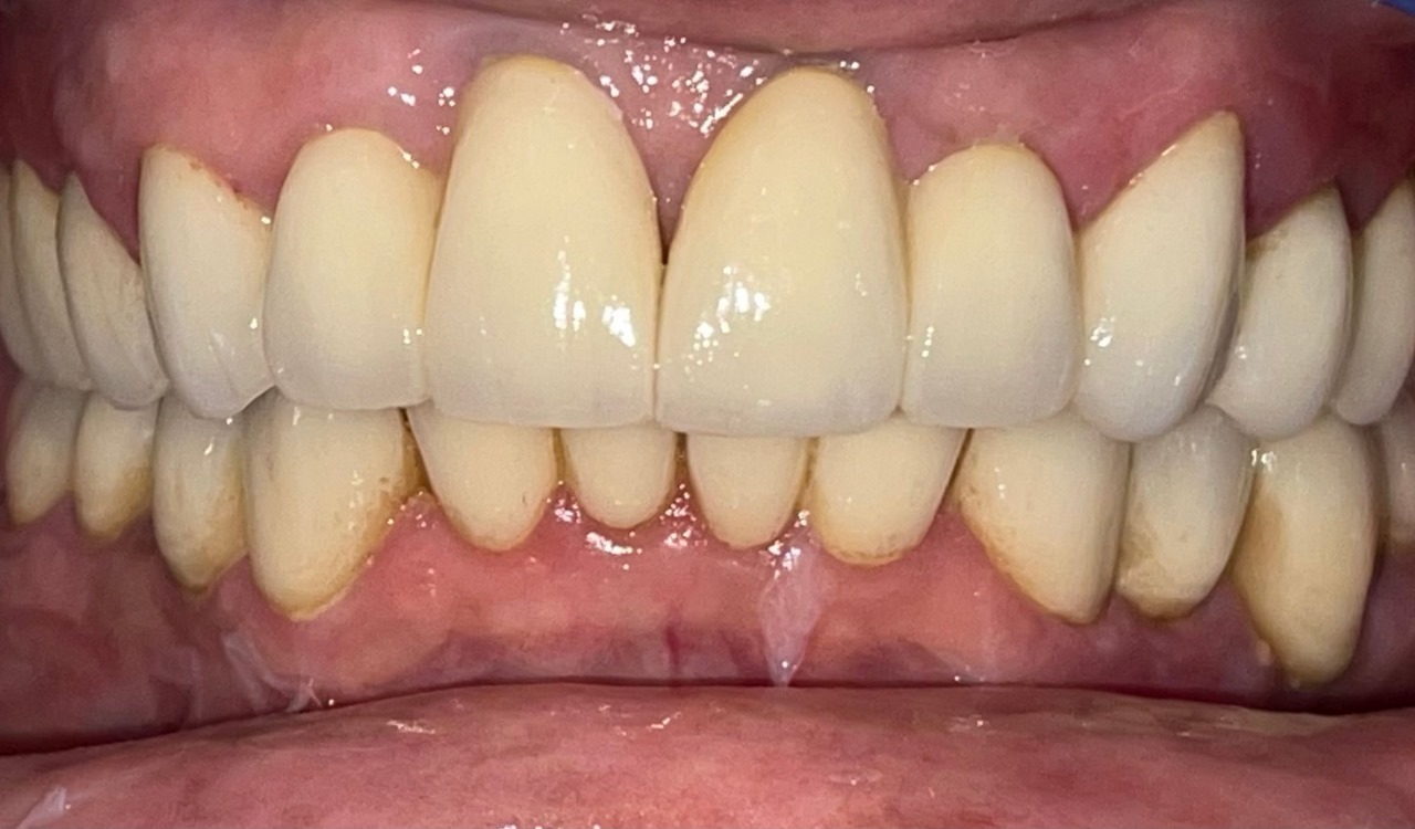 After Teeth