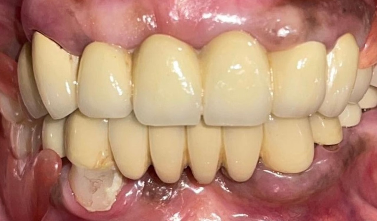 After Teeth