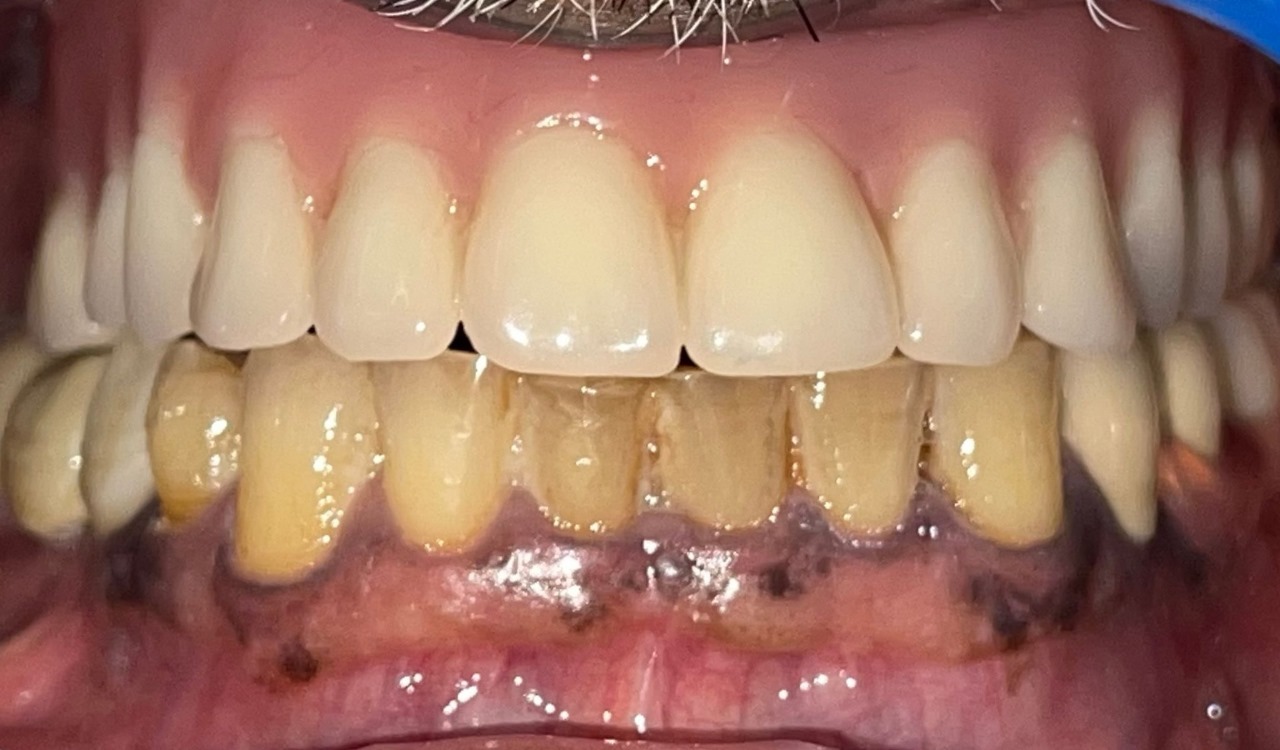 After Teeth
