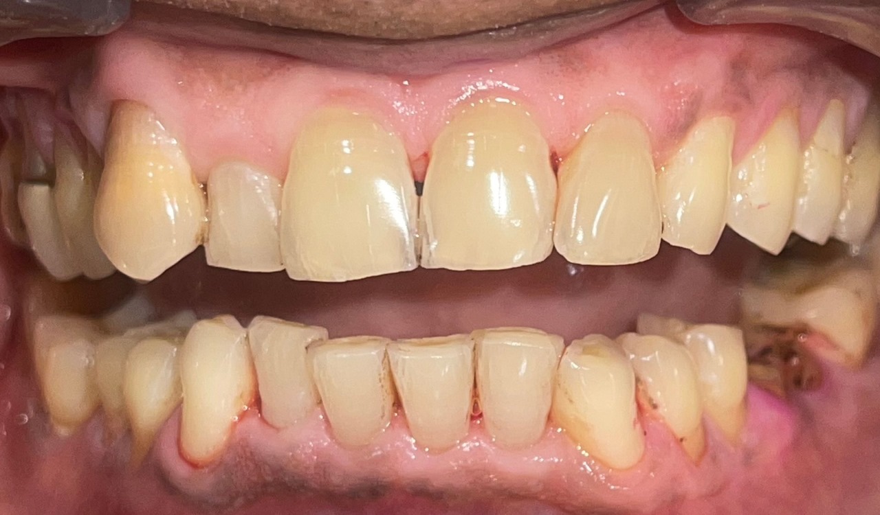After Teeth
