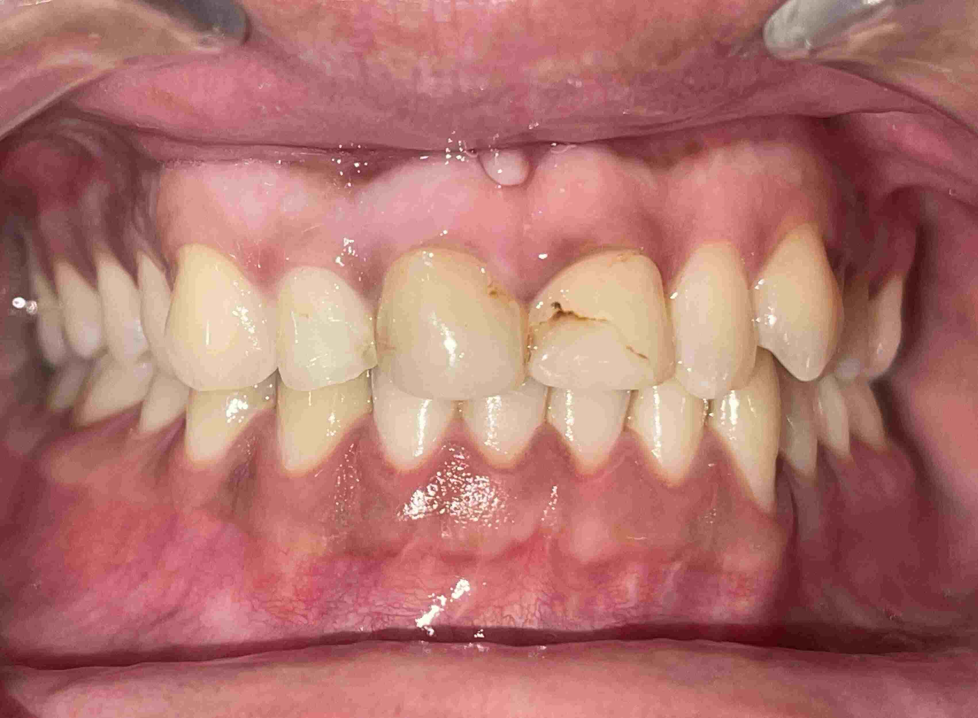 Before Teeth