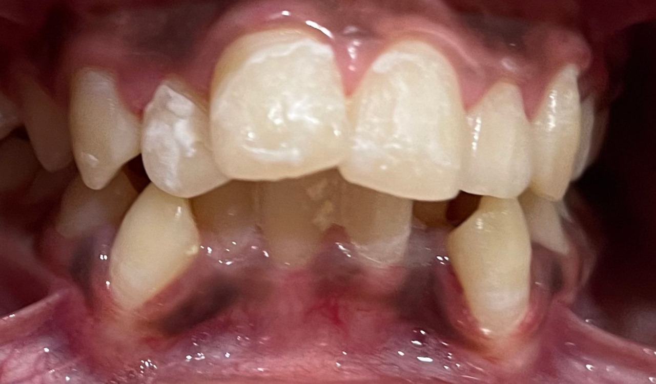 Before Teeth
