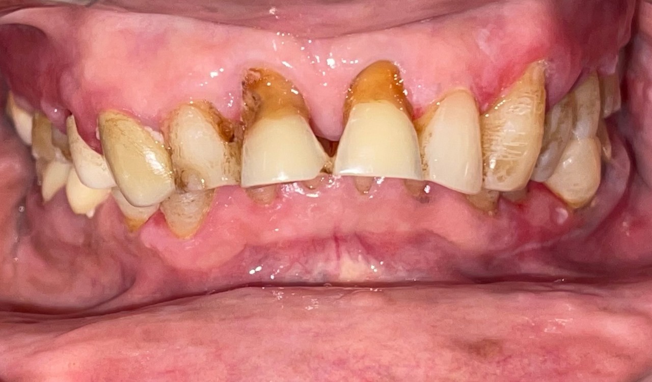 Before Teeth