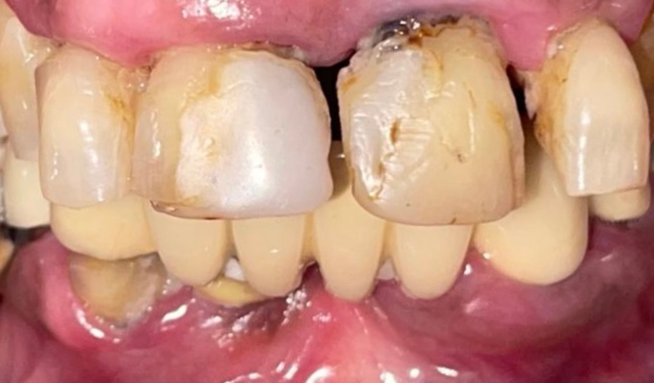 Before Teeth