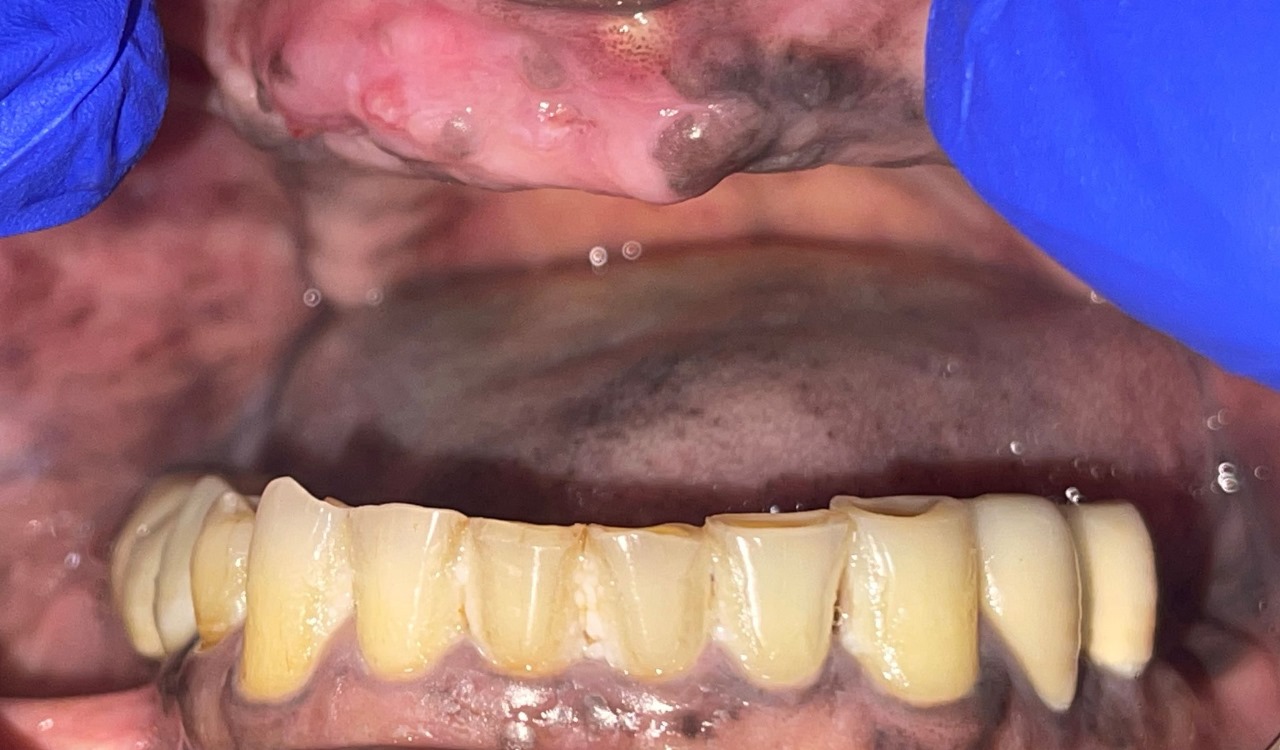 Before Teeth