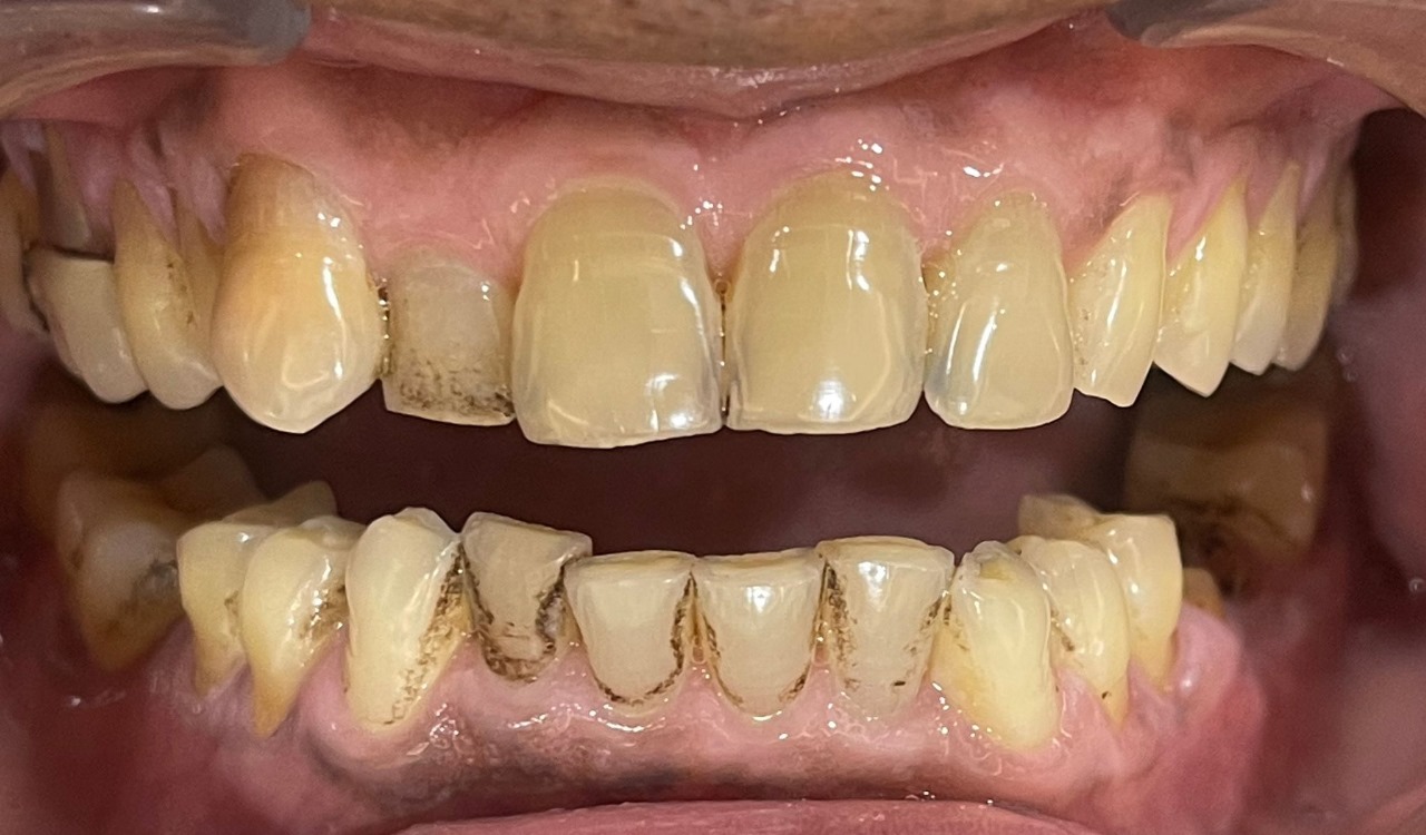 Before Teeth