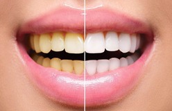 Teeth-Whitening