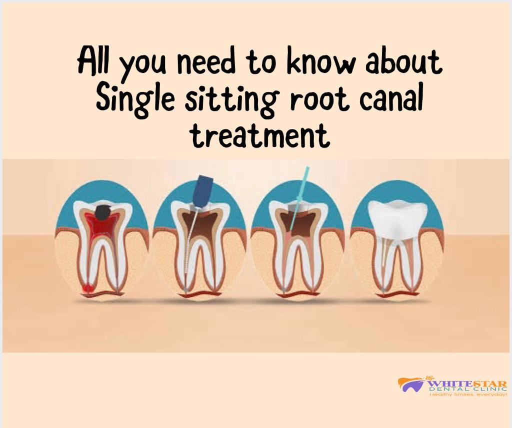 RCT Treatment Cost in Paschim Vihar