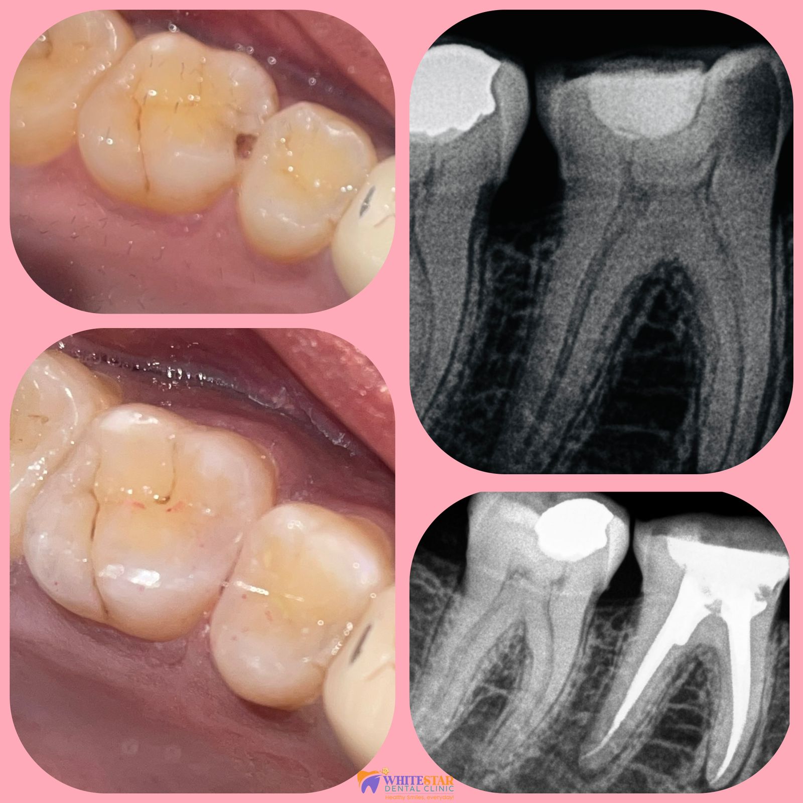 Best Dentist for Fillings Paschim Vihar