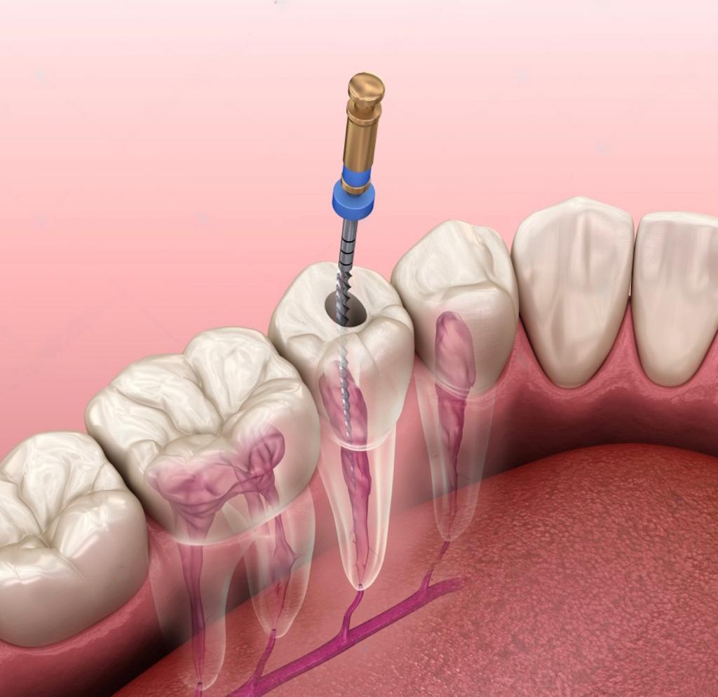 root canal treatment in west delhi