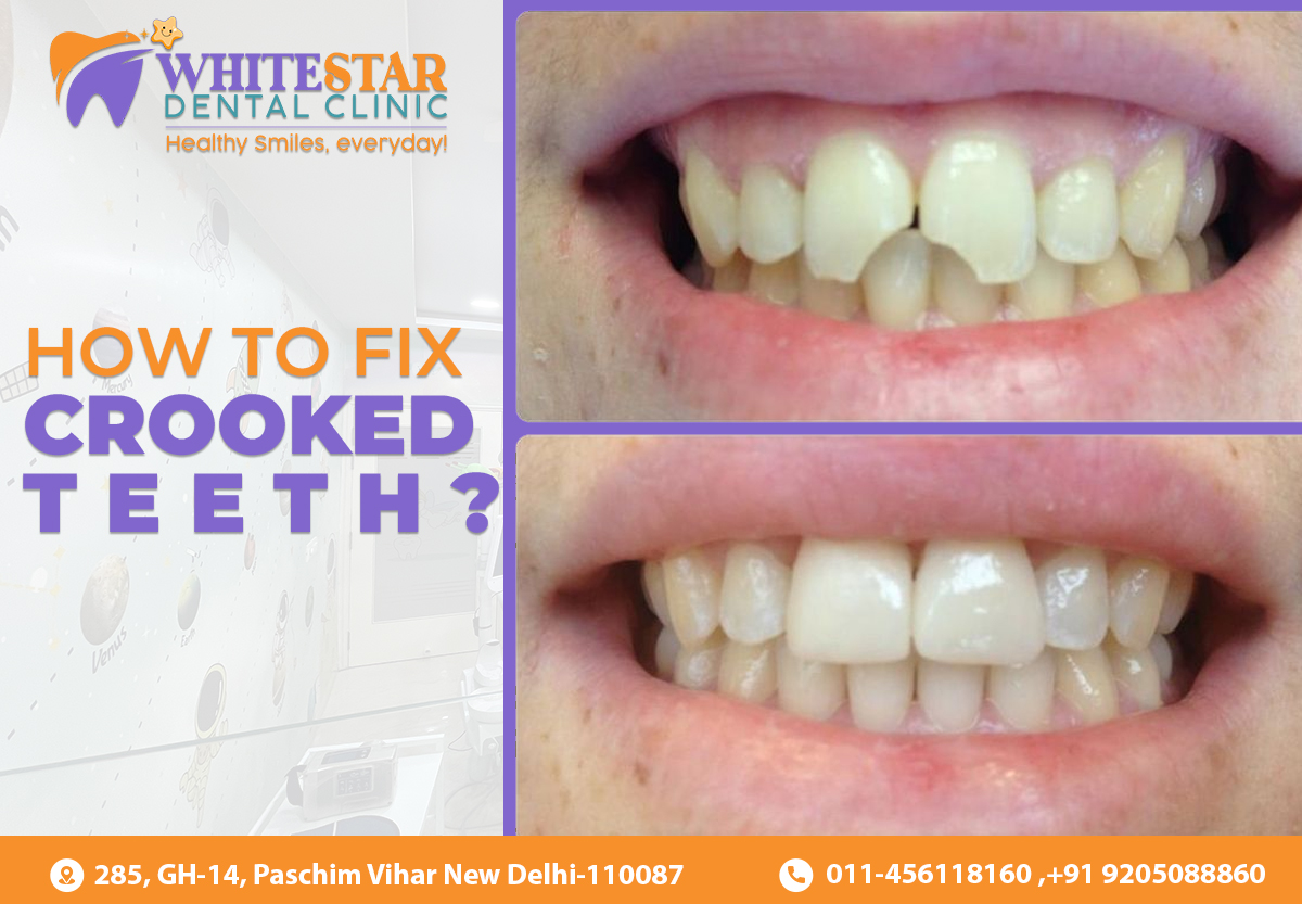 Crooked teeth and repaired teeth , white star dental clinic logo