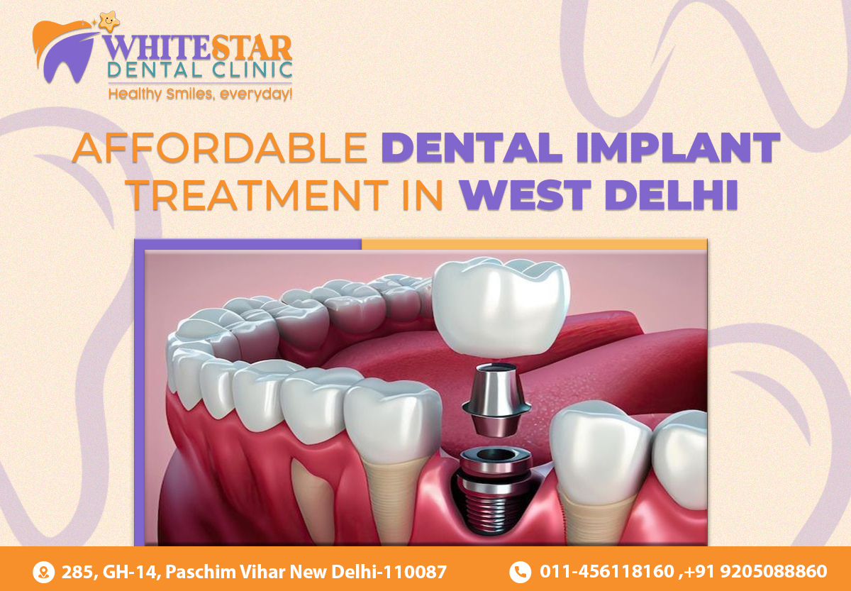 Affordable dental implant treatment in west delhi