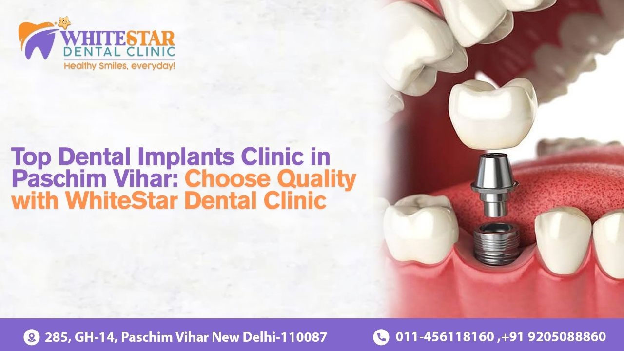 Dental Implants Clinic in Paschim Vihar – WhiteStar Dental Clinic with contact details and address.