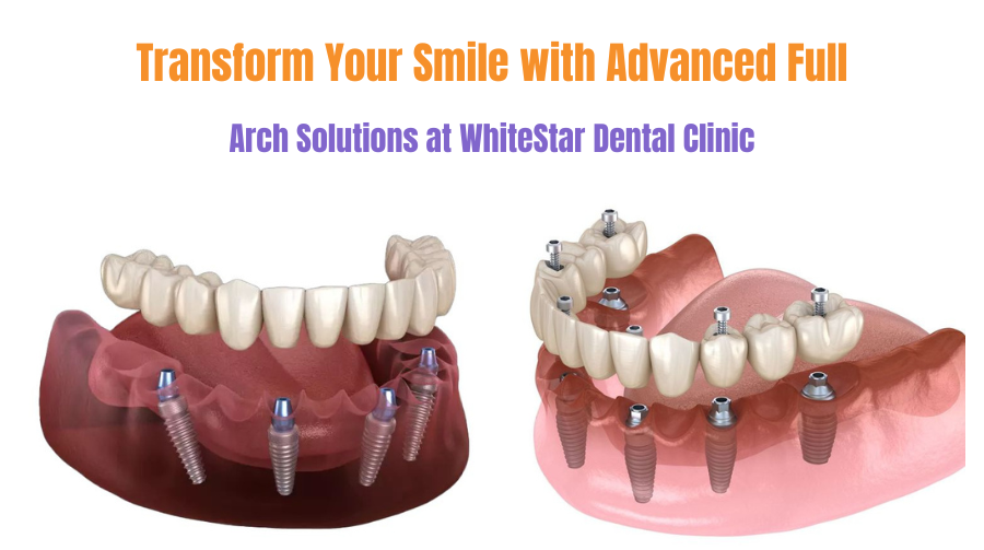 Full arch dental implants illustration showing upper and lower jaw restoration at WhiteStar Dental Clinic — advanced smile transformation treatment.